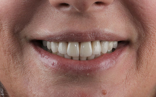 Эстетическая и функциональная реабилитация зубов