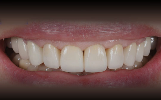 Функциональная и эстетическая реабилитация цельнокерамическими коронками на зубы и циркониевыми коронками на имплантаты