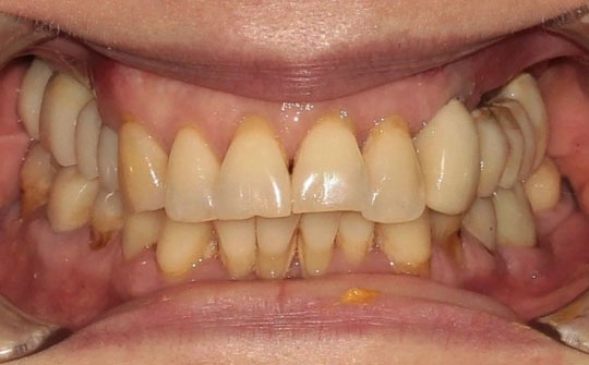 Эстетическая и функциональная реабилитация зубов